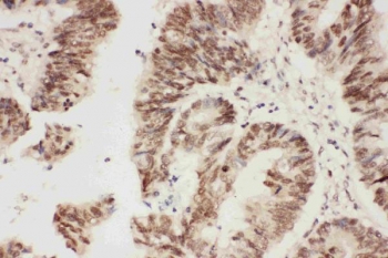 IHC staining of FFPE human rectal cancer with ALK antibody. HIER: boil tissue sections in pH6 citrate buffer for 20 min and allow to cool before testing.
