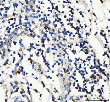 IHC staining of FFPE human lymph cancer tissue with IL2RA antibody. HIER: boil tissue sections in pH8 EDTA for 20 min and allow to cool before testing.
