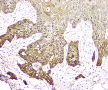 IHC staining of FFPE human esophagus squama cancer with 14-3-3 sigma antibody. HIER: boil tissue sections in pH8 EDTA for 20 min and allow to cool before testing.