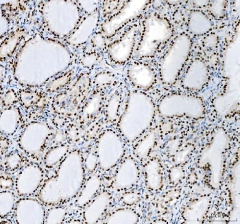 IHC staining of FFPE human thyroid cancer tissue with Nucleophosmin antibody. HIER: boil tissue sections in pH8 EDTA for 20 min and allow to cool before testing.