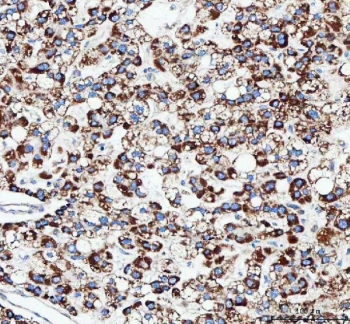 IHC staining of FFPE human liver cancer tissue with TFAM antibody. HIER: boil tissue sections in pH8 EDTA for 20 min and allow to cool before testing.