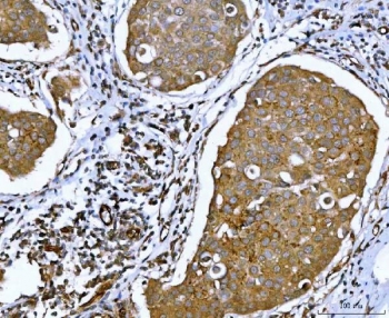 IHC staining of FFPE human breast cancer tissue with Ataxin-2 antibody. HIER: boil tissue sections in pH8 EDTA for 20 min and allow to cool before testing.