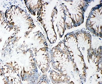 IHC-P: MMP14 antibody testing of human intestinal cancer tissue