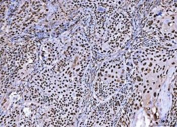 IHC staining of FFPE human laryngeal squamous cell carcinoma tissue with BRCA1 antibody. HIER: boil tissue sections in pH8 EDTA for 20 min and allow to cool before testing.