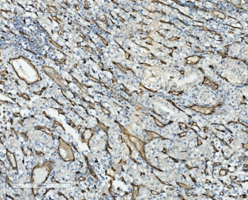 IHC staining of FFPE human glioma with CD34 antibody. HIER: boil tissue sections in pH8 EDTA for 20 min and allow to cool before testing.