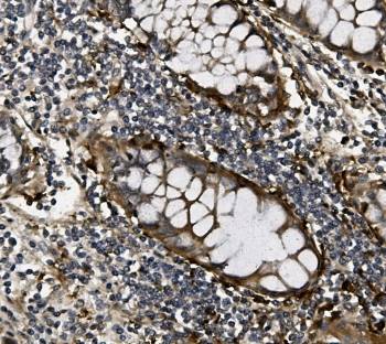 IHC staining of FFPE human rectal cancer with VEGF antibody. HIER: boil tissue sections in pH6, 10mM citrate buffer, for 20 min and allow to cool before testing.