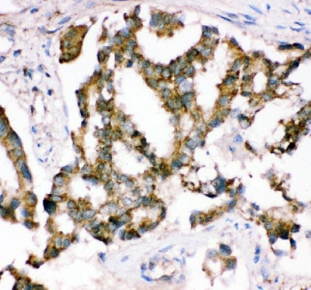 IHC staining of FFPE human lung cancer tissue with Crk antibody. HIER: boil tissue sections in pH8 EDTA for 20 min and allow to cool before testing.