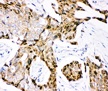 IHC-P: Ubiquitin antibody testing of human mammary cancer tissue