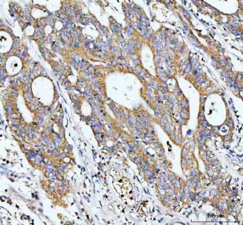 IHC staining of FFPE human colorectal cancer tissue with GCLC antibody. HIER: boil tissue sections in pH8 EDTA for 20 min and allow to cool before testing.