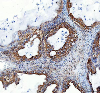 IHC staining of FFPE human lung cancer tissue with Heme Oxygenase 2 antibody. HIER: boil tissue sections in pH6 citrate buffer for 20 min and allow to cool before testing.