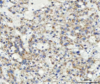 IHC staining of FFPE human liver cancer with ABCB4 antibody. HIER: boil tissue sections in pH8 EDTA buffer for 20 min and allow to cool before testing.