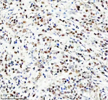 IHC staining of FFPE human breast cancer tissue with NEDD9 antibody. HIER: boil tissue sections in pH8 EDTA for 20 min and allow to cool before testing.