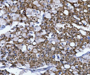 IHC staining of FFPE human liver cancer tissue with NUMB antibody. HIER: boil tissue sections in pH8 EDTA for 20 min and allow to cool before testing.