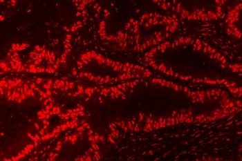Immunofluorescent staining of FFPE human intestinal cancer tissue with Nucleophosmin antibody. HIER: steam section in pH8 EDTA for 20 min.