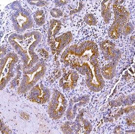 IHC staining of FFPE human adenosquamous carcinoma of the gall bladder with Optineurin antibody. HIER: boil tissue sections in pH8 EDTA for 20 min and allow to cool before testing.  