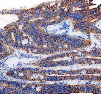 IHC staining of FFPE human colon cancer tissue with PGRMC1 antibody, HRP-secondary and DAB substrate. HIER: boil tissue sections in pH8 EDTA for 20 min and allow to cool before testing.