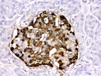 IHC testing of human pancreatic cancer tissue with GLP-1 antibody. HIER: Boil the paraffin sections in pH 6, 10mM citrate buffer for 20 minutes and allow to cool prior to staining.