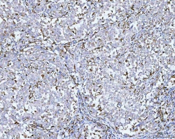 IHC staining of FFPE human lung cancer tissue with CD14 antibody. HIER: boil tissue sections in pH8 EDTA for 20 min and allow to cool before testing.