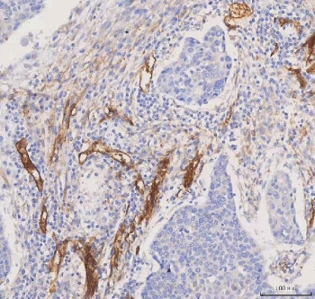 IHC staining of FFPE human bladder urothelial carcinoma tissue with Aquaporin 1 antibody. HIER: boil tissue sections in pH8 EDTA for 20 min and allow to cool before testing.