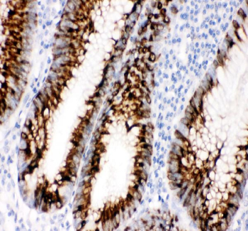 IHC staining of FFPE human colon cancer tissue with CCL11 antibody, HRP-secondary and DAB substrate. HIER: boil tissue sections in pH8 EDTA for 20 min and allow to cool before testing.