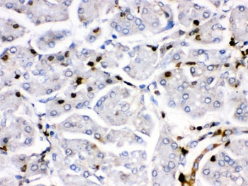 IHC testing of FFPE human pancreatic cancer tissue with Fos B antibody. HIER: Boil the paraffin sections in pH 6, 10mM citrate buffer for 20 minutes and allow to cool prior to staining.