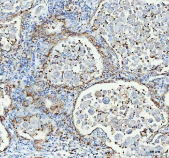 IHC testing of FFPE human lung cancer tissue with AQP4 antibody. HIER: Boil the paraffin sections in pH 8 EDTA buffer for 20 minutes and allow to cool prior to staining.