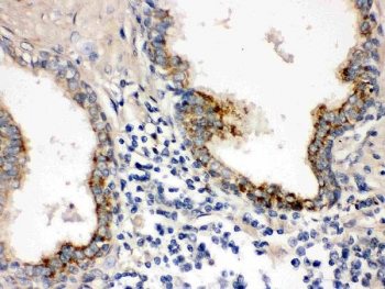 IHC testing of FFPE human prostate cancer with PTP4A2 antibody. HIER: Boil the paraffin sections in pH 6, 10mM citrate buffer for 20 minutes and allow to cool prior to staining.