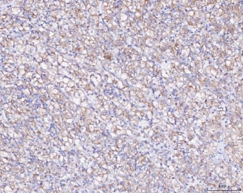 IHC staining of FFPE human glioma tissue with ATX2 antibody. HIER: boil tissue sections in pH8 EDTA for 20 min and allow to cool before testing.