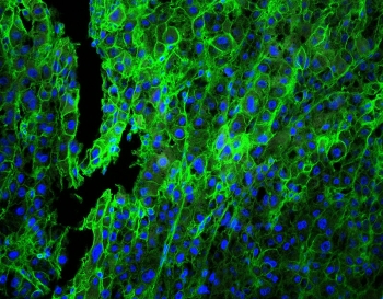 Immunofluorescent staining of FFPE human lung cancer with HLA-C antibody (green) at 1ug/ml and DAPI nuclear stain. HIER: boil tissue sections in pH6, 10mM citrate buffer, for 10-20 min and allow to cool before testing.