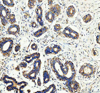 IHC staining of FFPE human breast cancer tissue with WDR1 antibody, HRP-secondary and DAB substrate. HIER: boil tissue sections in pH8 EDTA for 20 min and allow to cool before testing.