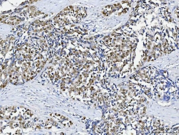 IHC testing of FFPE human gallbladder carcinoma tissue with ABL2 antibody. HEIR: Boil the paraffin sections in pH8 EDTA buffer for 20 minutes and allow to cool prior to testing.