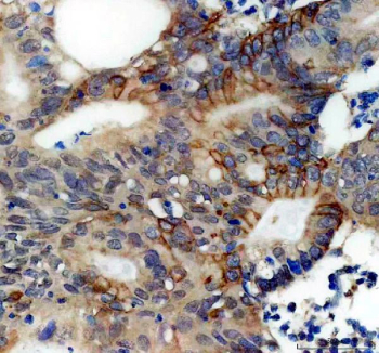 IHC staining of FFPE human colon cancer tissue with Perilipin 3 antibody, HRP-secondary and DAB substrate. HIER: boil tissue sections in pH8 EDTA for 20 min and allow to cool before testing.