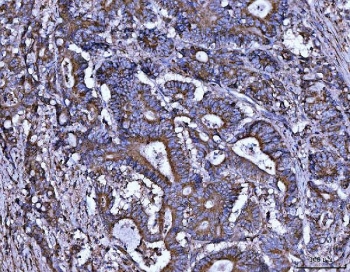 IHC staining of FFPE human stomach cancer with ALDH1A2 antibody. HIER: boil tissue sections in pH8 EDTA for 20 min and allow to cool before testing.