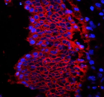Immunofluorescent staining of human rectal cancer tissue with EpCAM antibody (red) and DAPI (blue). HIER: steam sections in pH6 citrate buffer for 20 min.