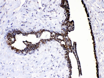 IHC testing of FFPE human breast cancer tissue with CASP8 antibody at 1ug/ml. HIER: steam section in pH6 citrate buffer for 20 min.