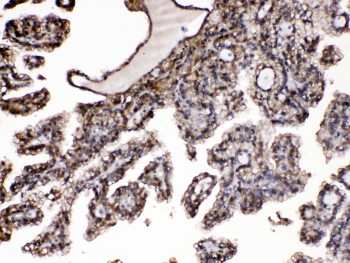 IHC testing of FFPE human renal cancer tissue with Purine nucleoside phosphorylase antibody at 1ug/ml. HIER: steam section in pH6 citrate buffer for 20 min.