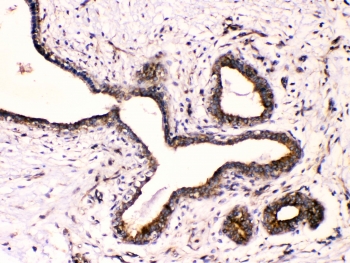 IHC testing of FFPE human breast cancer with Beta III Tubulin antibody at 1ug/ml. HIER: steam section in pH6 citrate buffer for 20 min.