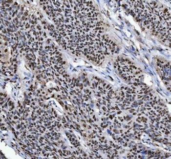 IHC staining of FFPE human laryngeal squamous cell carcinoma tissue with hnRNP L antibody. HIER: boil tissue sections in pH8 EDTA for 20 min and allow to cool before testing.