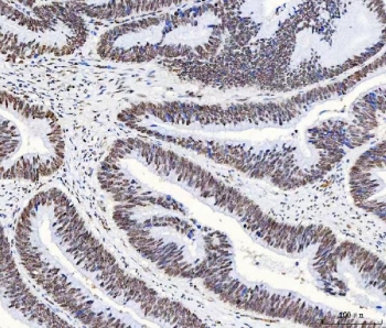 IHC staining of FFPE human colorectal adenocarcinoma tissue with hnRNP H antibody. HIER: boil tissue sections in pH8 EDTA for 20 min and allow to cool before testing.