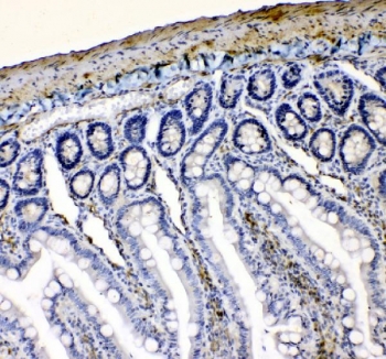 IHC testing of FFPE human lung cancer tissue with VASP antibody at 1ug/ml. HIER: steam section in pH6 citrate buffer for 20 min.