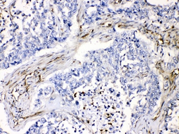 IHC testing of FFPE human lung cancer tissue with VASP antibody at 1ug/ml. HIER: steam section in pH6 citrate buffer for 20 min.