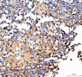 IHC staining of FFPE human lymphoma tissue with Survivin antibody. HIER: boil tissue sections in pH8 EDTA for 20 min and allow to cool before testing.