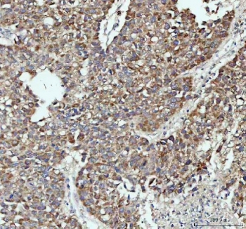 IHC staining of FFPE human liver cancer tissue with PAH antibody. HIER: boil tissue sections in pH8 EDTA for 20 min and allow to cool before testing.