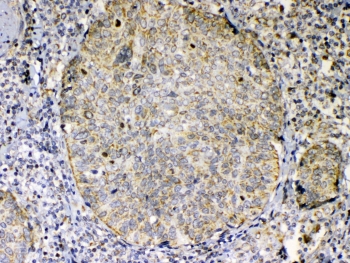 IHC testing of FFPE human lung cancer tissue with TNFSF18 antibody at 1ug/ml. Required HIER: steam section in pH6 citrate buffer for 20 min and allow to cool prior to testing.