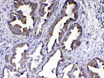 IHC testing of FFPE human lung cancer tissue with AMD1 antibody at 1ug/ml. Required HIER: steam section in pH6 citrate buffer for 20 min and allow to cool prior to testing.