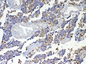 IHC testing of FFPE human lung cancer tissue with Dnmt1 antibody at 1ug/ml. Required HIER: steam section in pH6 citrate buffer for 20 min and allow to cool prior to testing.
