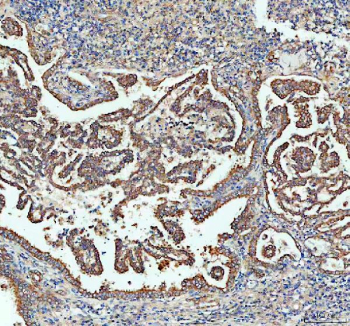 IHC staining of FFPE human lung cancer tissue with Sacsin antibody, HRP-labeled secondary and DAB substrate. HIER: boil tissue sections in pH8 EDTA for 20 min and allow to cool before testing.