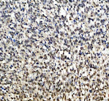 IHC staining of FFPE human melanoma tissue with SOX10 antibody. HIER: boil tissue sections in pH8 EDTA for 20 min and allow to cool before testing.