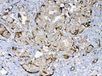 IHC testing of FFPE human breast cancer tissue with GAD65 antibody at 1ug/ml. Required HIER: steam section in pH6 citrate buffer for 20 min and allow to cool prior to testing.