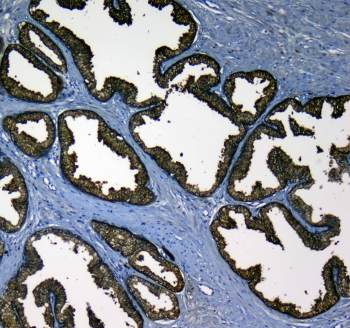 IHC testing of FFPE human prostate cancer tissue with KLK2 antibody at 1ug/ml. Required HIER: steam section in pH6 citrate buffer for 20 min and allow to cool prior to testing.